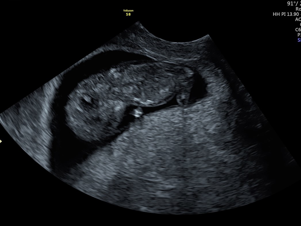 Scan From 12 Weeks | firstScan Clinic Window to the Womb