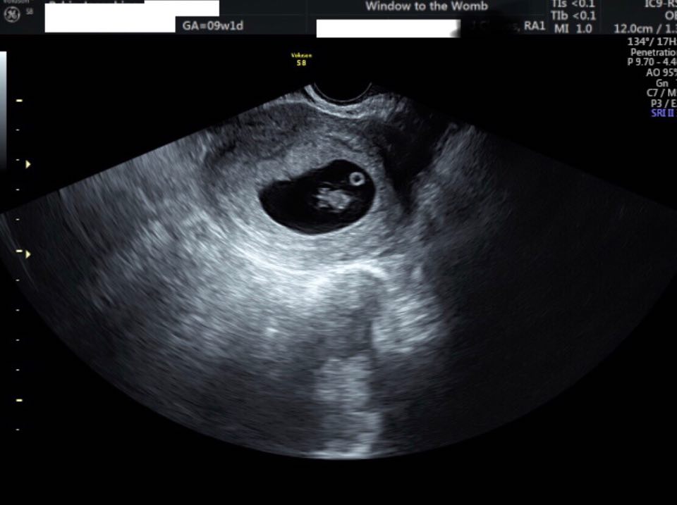 Specialist Ectopic Pregnancy | firstScan at Window to the Womb