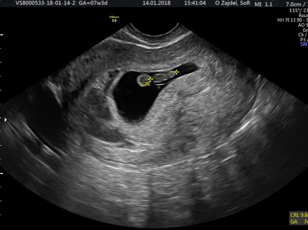 Pregnancy Dating Scan From 8+ Weeks | firstScan Window to the Womb